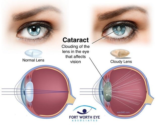 Cataract - Coward